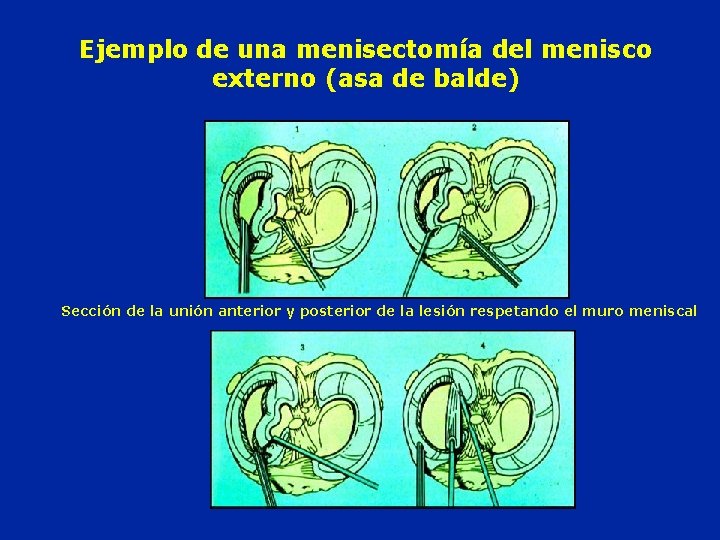 Ejemplo de una menisectomía del menisco externo (asa de balde) Sección de la unión