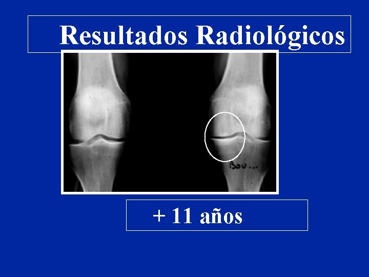 Resultados Radiológicos + 11 años 