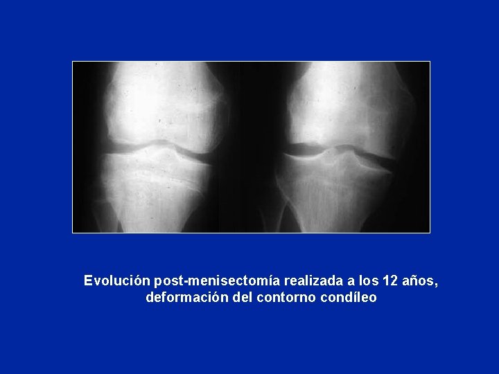 Evolución post-menisectomía realizada a los 12 años, deformación del contorno condíleo 