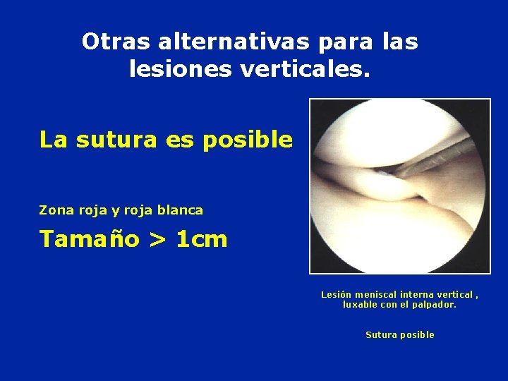 Otras alternativas para las lesiones verticales. La sutura es posible Tamaño > 1 cm