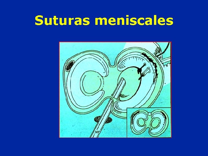 Suturas meniscales 