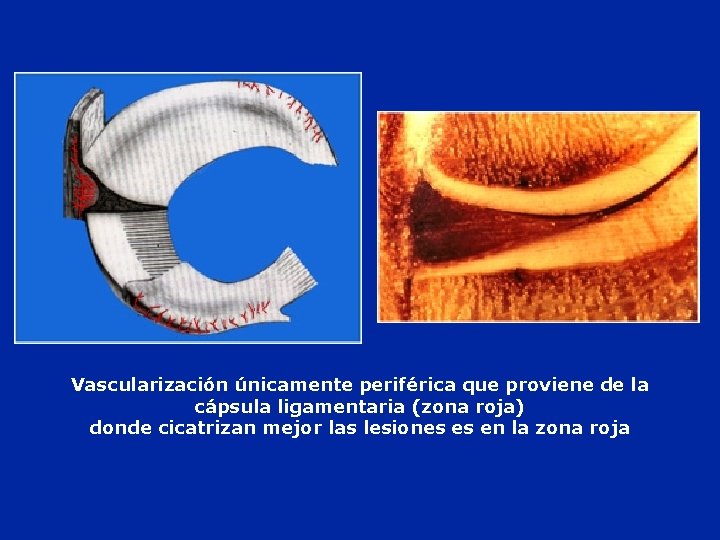 Vascularización únicamente periférica que proviene de la cápsula ligamentaria (zona roja) donde cicatrizan mejor