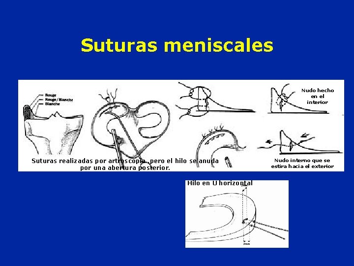 Suturas meniscales Nudo hecho en el interior Suturas realizadas por artroscopia , pero el