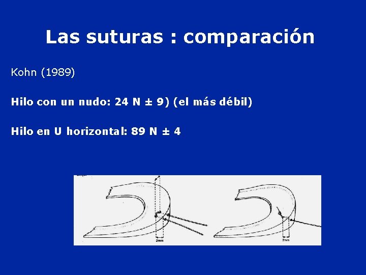 Las suturas : comparación Kohn (1989) Hilo con un nudo: 24 N ± 9)