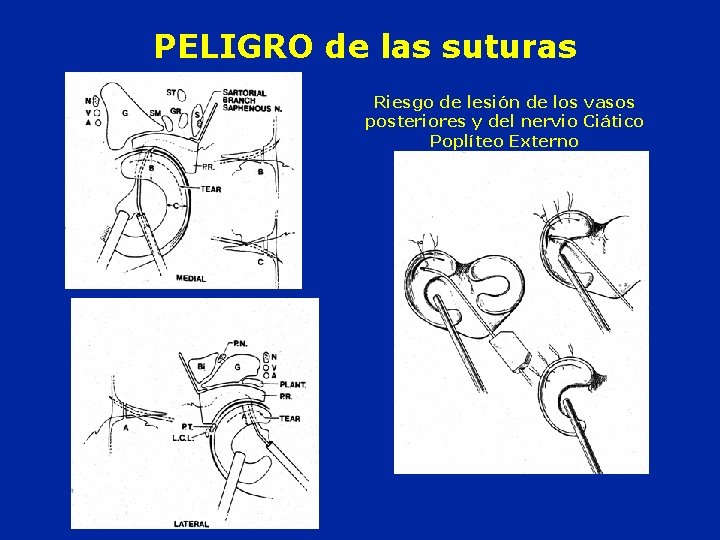 PELIGRO de las suturas Riesgo de lesión de los vasos posteriores y del nervio