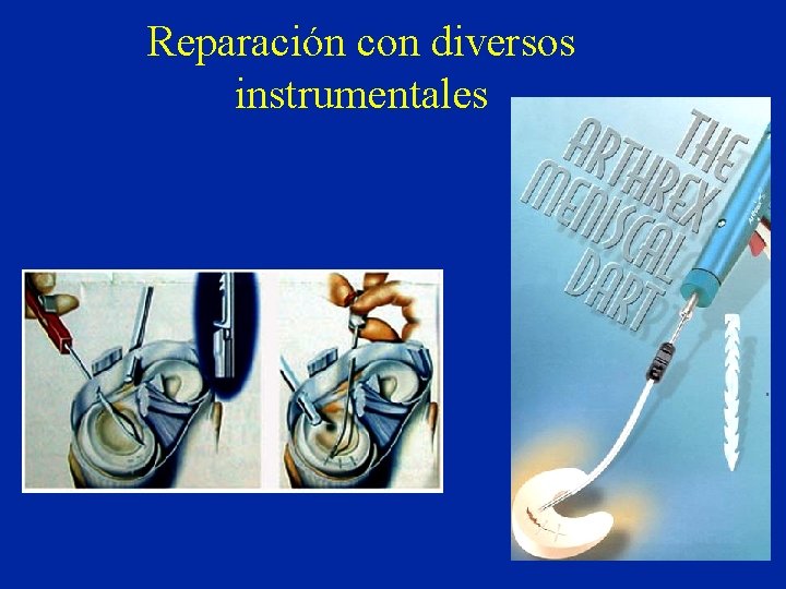 Reparación con diversos instrumentales 