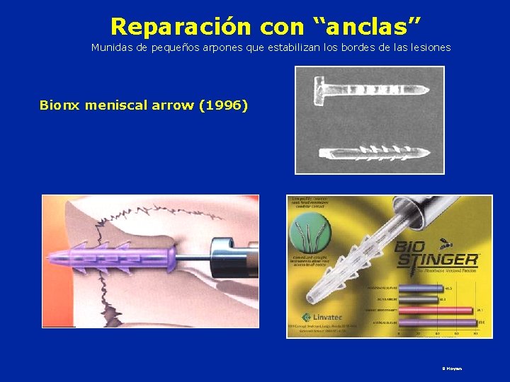 Reparación con “anclas” Munidas de pequeños arpones que estabilizan los bordes de las lesiones