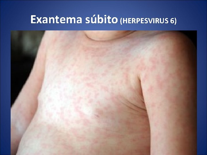 Exantema súbito (HERPESVIRUS 6) 