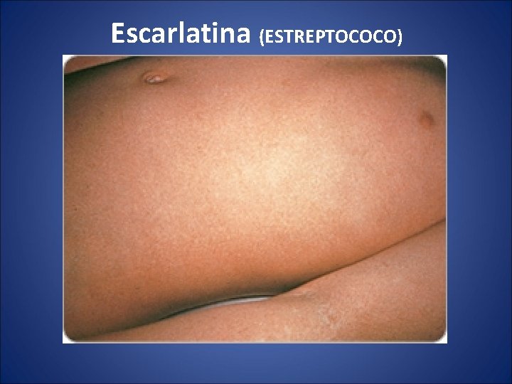 Escarlatina (ESTREPTOCOCO) 