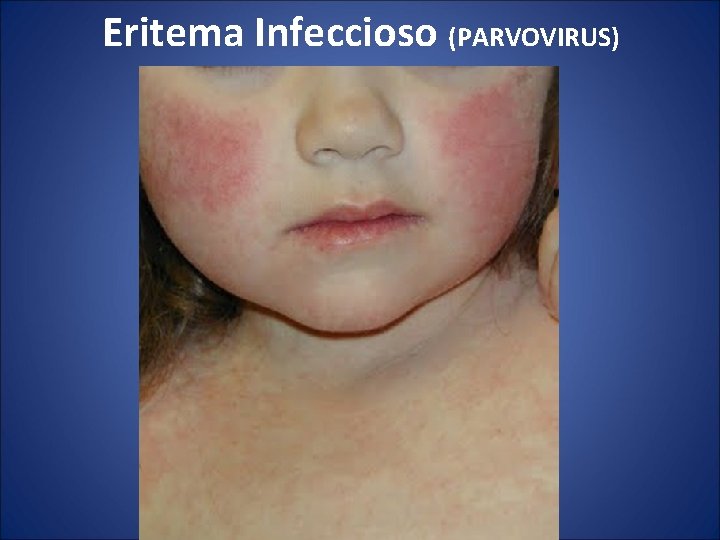 Eritema Infeccioso (PARVOVIRUS) 