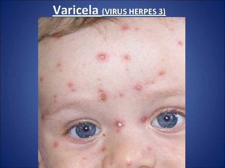 Varicela (VIRUS HERPES 3) 