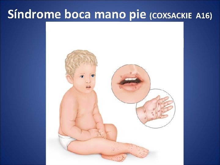 Síndrome boca mano pie (COXSACKIE A 16) 