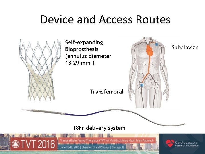 Device and Access Routes Self-expanding Bioprosthesis (annulus diameter 18 -29 mm ) Transfemoral 18