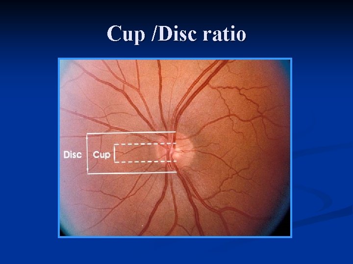 Cup /Disc ratio 