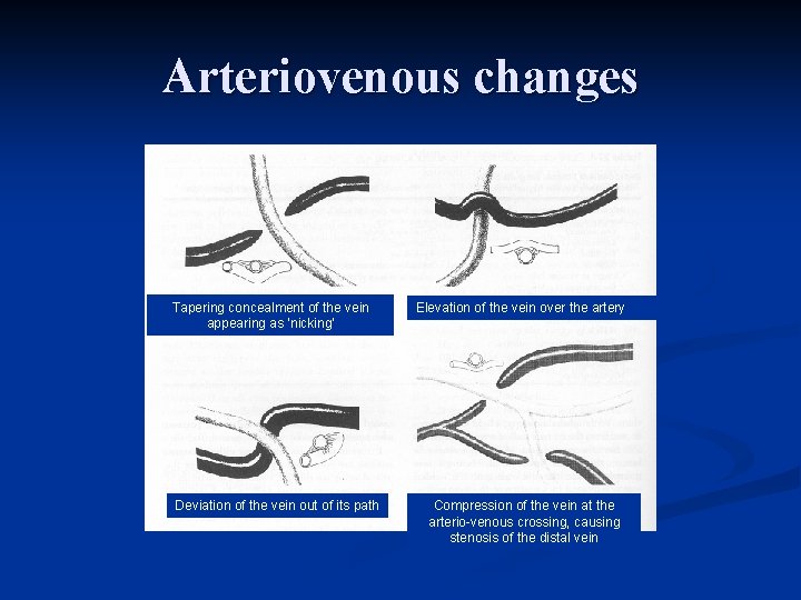 Arteriovenous changes Tapering concealment of the vein appearing as ‘nicking’ Deviation of the vein