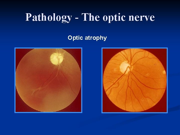 Pathology - The optic nerve Optic atrophy 