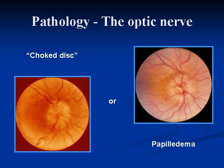 Pathology - The optic nerve “Choked disc” or Papilledema 