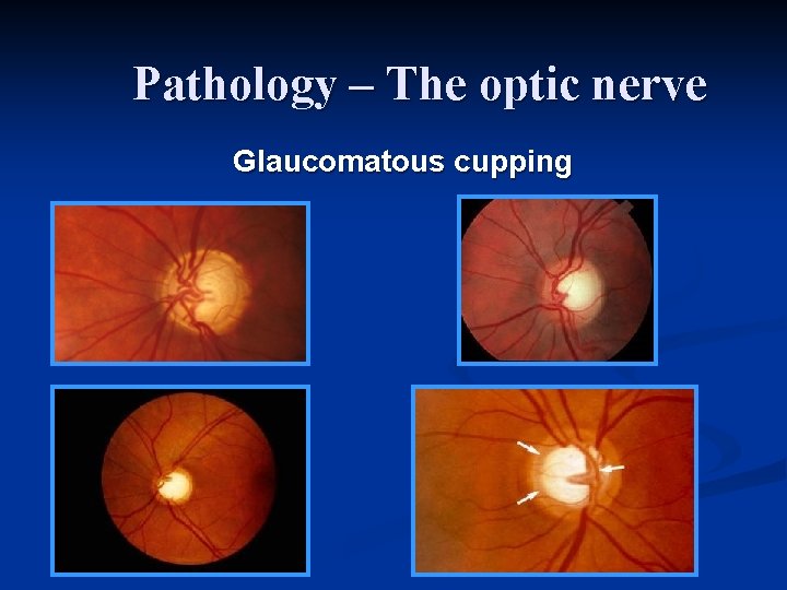 Pathology – The optic nerve Glaucomatous cupping 