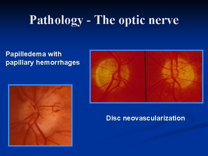 Pathology - The optic nerve Papilledema with papillary hemorrhages Disc neovascularization 