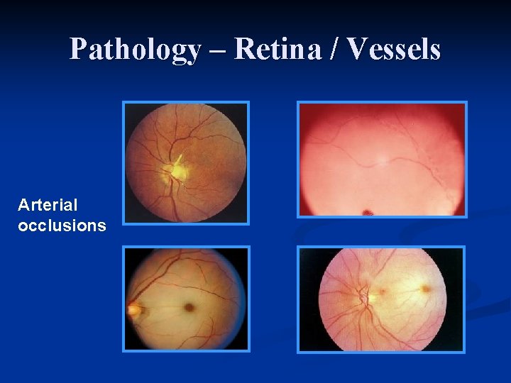 Pathology – Retina / Vessels Arterial occlusions 