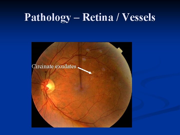 Pathology – Retina / Vessels Circinate exudates 