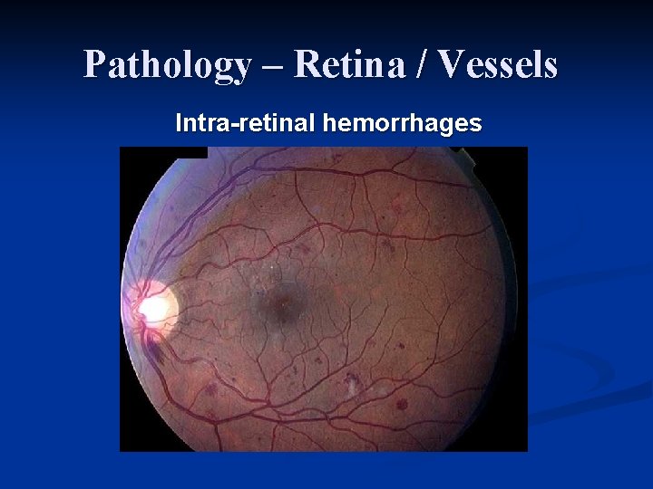 Pathology – Retina / Vessels Intra-retinal hemorrhages 