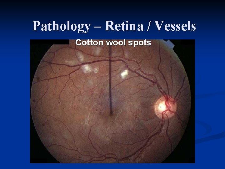 Pathology – Retina / Vessels Cotton wool spots 