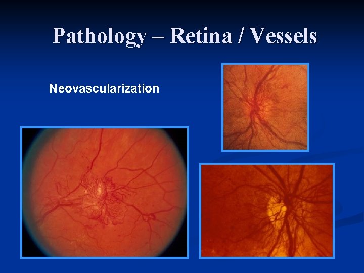 Pathology – Retina / Vessels Neovascularization 