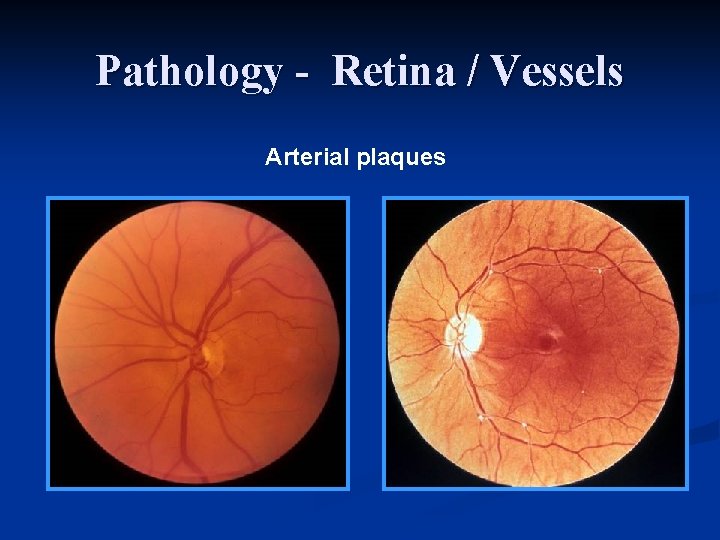 Pathology - Retina / Vessels Arterial plaques 