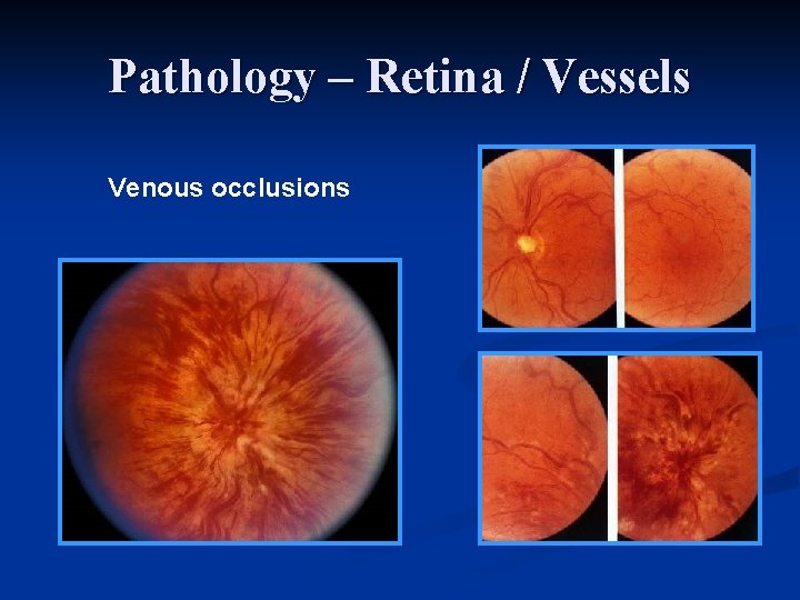 Pathology – Retina / Vessels Venous occlusions 