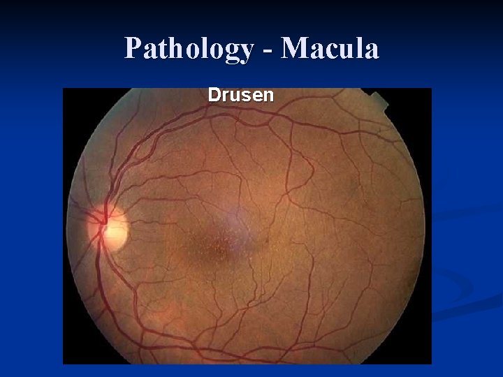 Pathology - Macula Drusen 