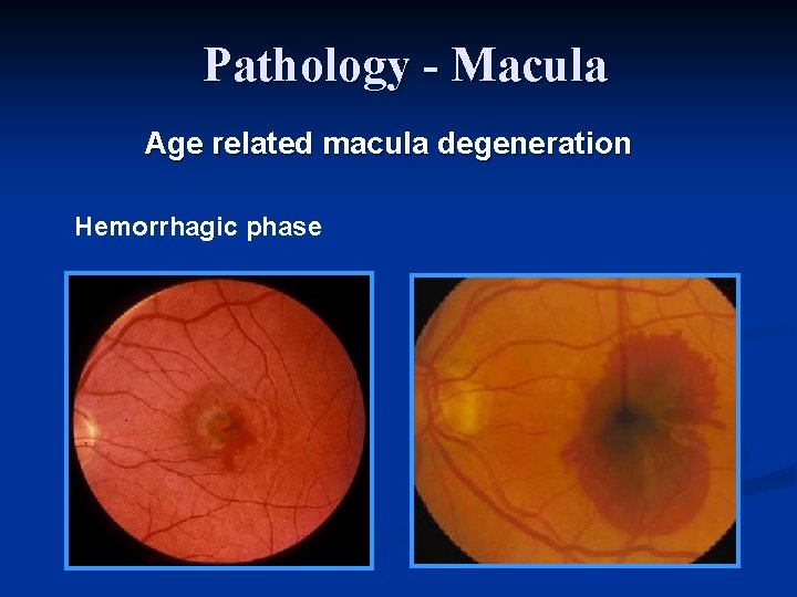 Pathology - Macula Age related macula degeneration Hemorrhagic phase 