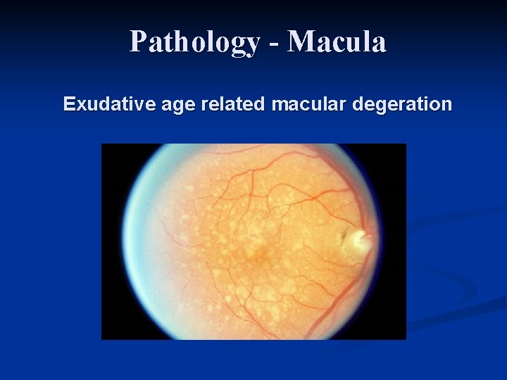 Pathology - Macula Exudative age related macular degeration 