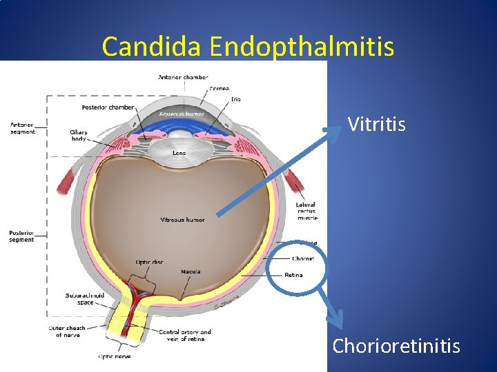 Candida Endopthalmitis Vitritis Chorioretinitis 