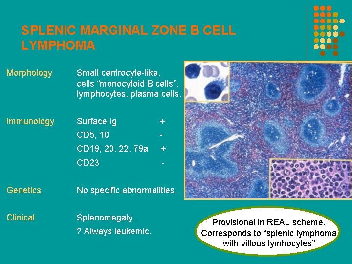 SPLENIC MARGINAL ZONE B CELL LYMPHOMA Morphology Small centrocyte-like, cells “monocytoid B cells”, lymphocytes,