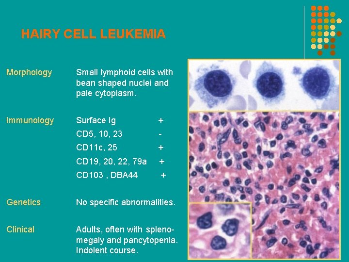 HAIRY CELL LEUKEMIA Morphology Small lymphoid cells with bean shaped nuclei and pale cytoplasm.