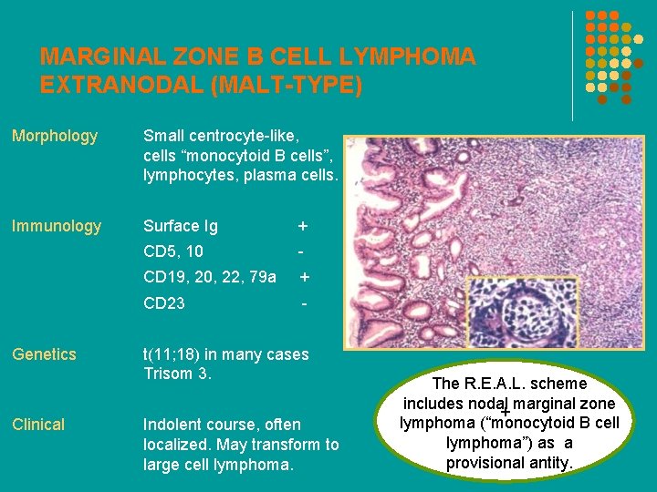 MARGINAL ZONE B CELL LYMPHOMA EXTRANODAL (MALT-TYPE) Morphology Small centrocyte-like, cells “monocytoid B cells”,