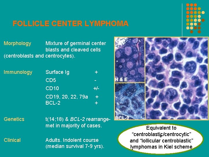 FOLLICLE CENTER LYMPHOMA Morphology Mixture of germinal center blasts and cleaved cells (centroblasts and