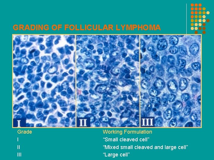 GRADING OF FOLLICULAR LYMPHOMA Grade I II III Working Formulation “Small cleaved cell” “Mixed