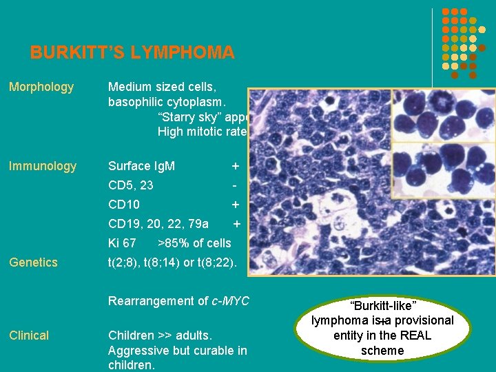 BURKITT’S LYMPHOMA Morphology Medium sized cells, basophilic cytoplasm. “Starry sky” appearance. High mitotic rate.