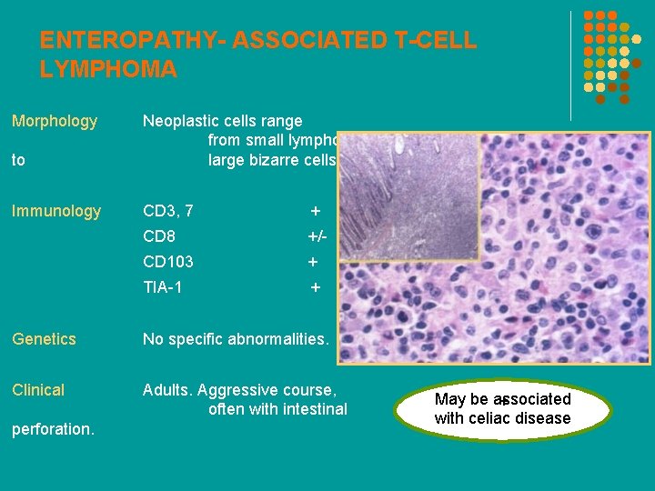 ENTEROPATHY- ASSOCIATED T-CELL LYMPHOMA Morphology to Neoplastic cells range from small lymphocytes large bizarre