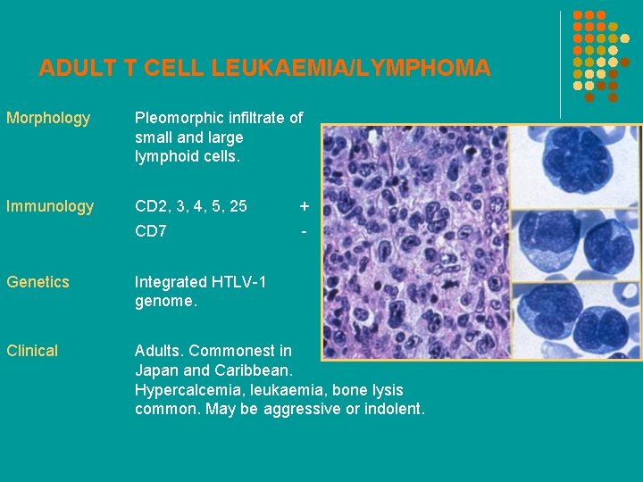 ADULT T CELL LEUKAEMIA/LYMPHOMA Morphology Pleomorphic infiltrate of small and large lymphoid cells. Immunology