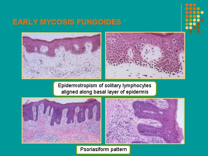 EARLY MYCOSIS FUNGOIDES Epidermotropism of solitary lymphocytes aligned along basal layer of epidermis Psoriasiform