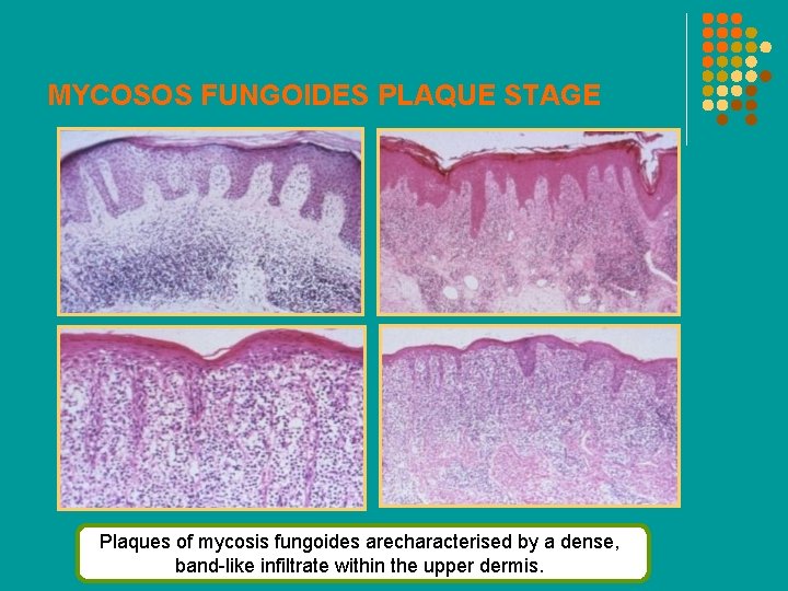 MYCOSOS FUNGOIDES PLAQUE STAGE Plaques of mycosis fungoides arecharacterised by a dense, band-like infiltrate