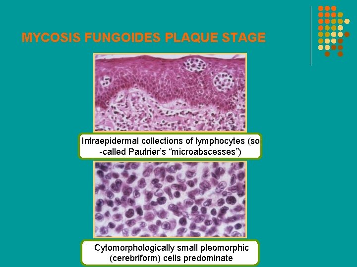 MYCOSIS FUNGOIDES PLAQUE STAGE Intraepidermal collections of lymphocytes (so -called Pautrier’s “microabscesses”) Cytomorphologically small