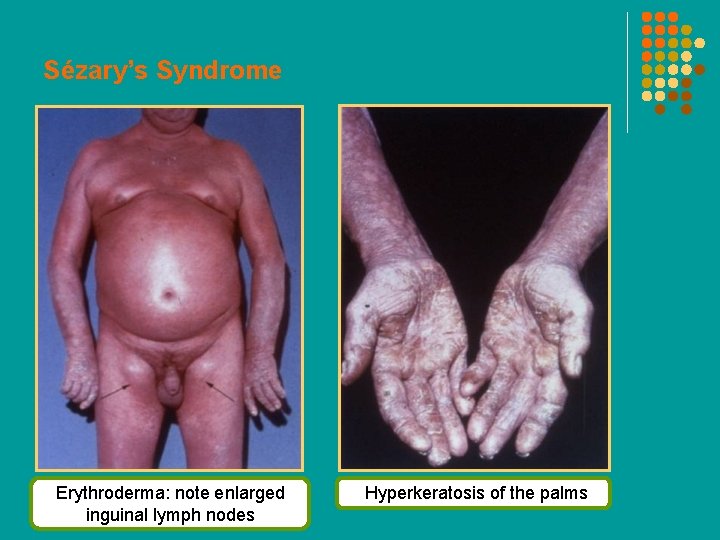 Sézary’s Syndrome Erythroderma: note enlarged inguinal lymph nodes Hyperkeratosis of the palms 