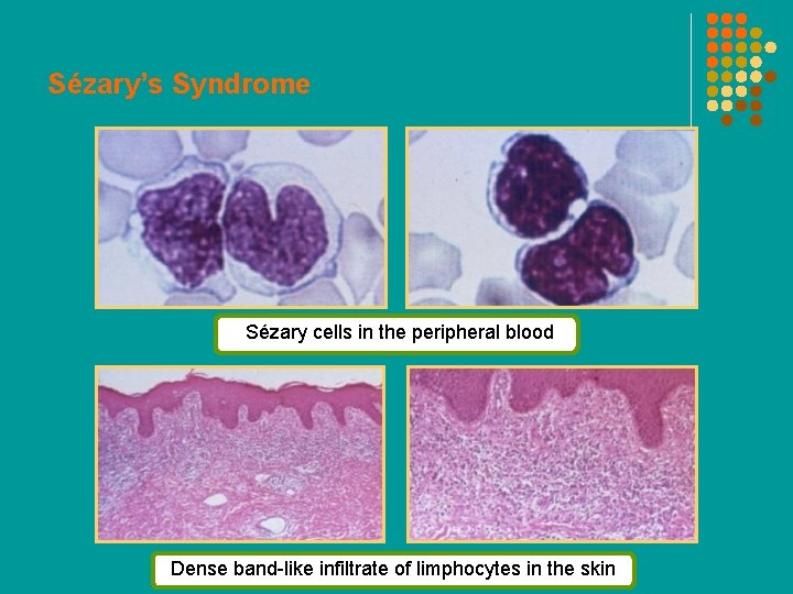 Sézary’s Syndrome Sézary cells in the peripheral blood Dense band-like infiltrate of limphocytes in