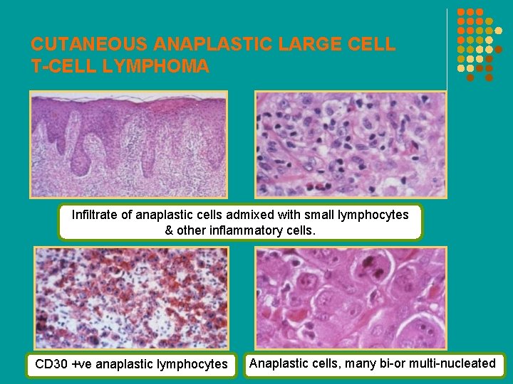 CUTANEOUS ANAPLASTIC LARGE CELL T-CELL LYMPHOMA Infiltrate of anaplastic cells admixed with small lymphocytes