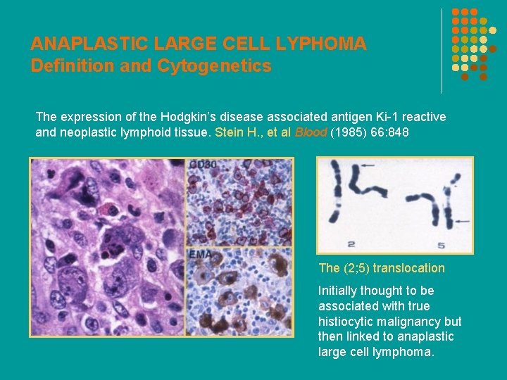 ANAPLASTIC LARGE CELL LYPHOMA Definition and Cytogenetics The expression of the Hodgkin’s disease associated