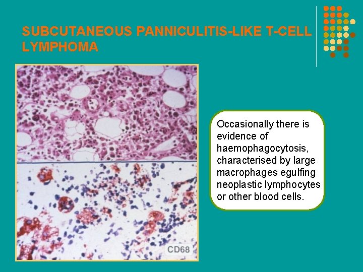 SUBCUTANEOUS PANNICULITIS-LIKE T-CELL LYMPHOMA Occasionally there is evidence of haemophagocytosis, characterised by large macrophages